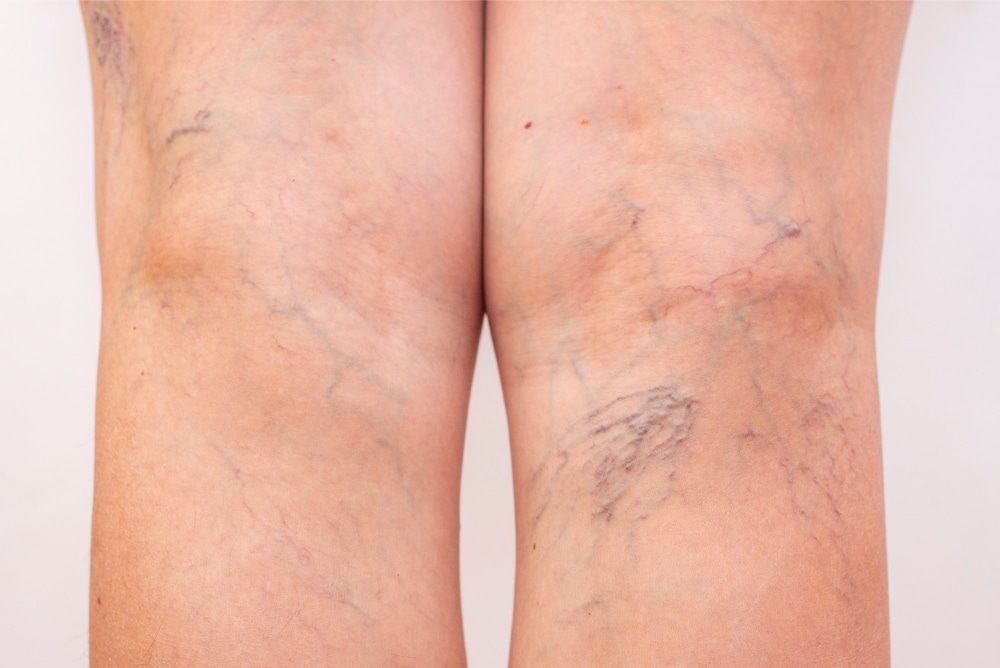 female legs with varicose veins leg spiders