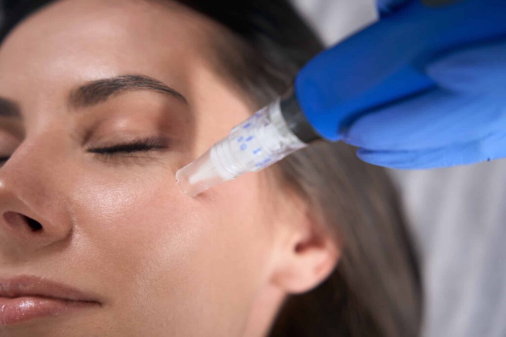 Transform Your Skin with Microneedling at Ashburn Laser & Skincare MedSpa