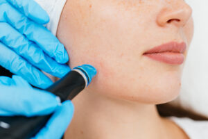 Young woman receiving facial treatment in a professional beauty salon. A close up cosmetologist manipulates a hydropeeling machine to clean and rejuvenate a patient's skin in a modern clinic.